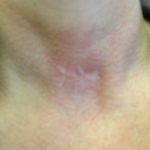 medical re-coloration