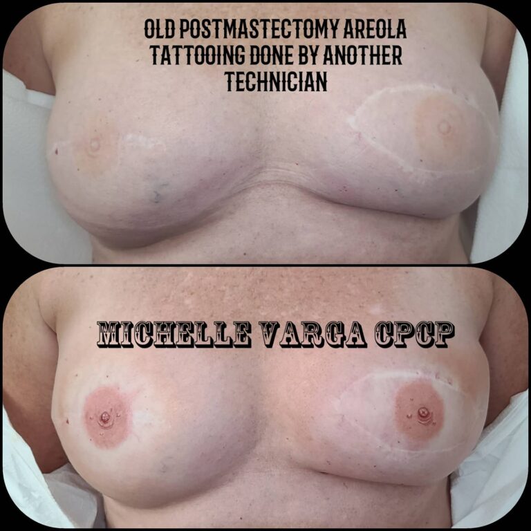 Areola 3